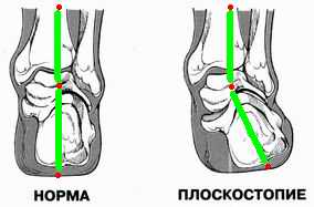 Отводящая мышца большого пальца ноги